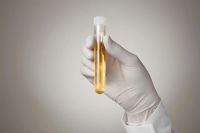 Un test d’urine pour détecter le cancer de la vessie : une innovation sherbrookoise en voie de révolutionner la médecine